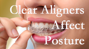 Clear aligners influence posture which Juneau chiropractic helps.