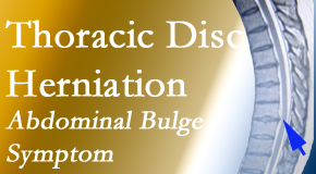 Aurora Chiropractic Center treats thoracic disc herniation that for some patients prompts abdominal pain.