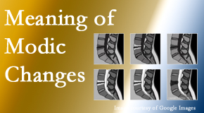 Aurora Chiropractic Center sees many back pain and neck pain patients who bring their MRIs with them to the office. Modic changes are often seen. 