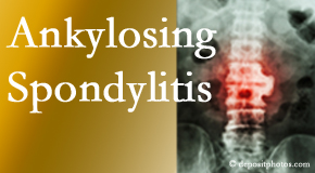 Ankylosing spondylitis is gently cared for by your Juneau chiropractor.