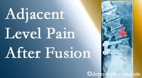 Aurora Chiropractic Center offers relieving care non-surgically to back pain patients suffering with adjacent level pain after spinal fusion surgery.