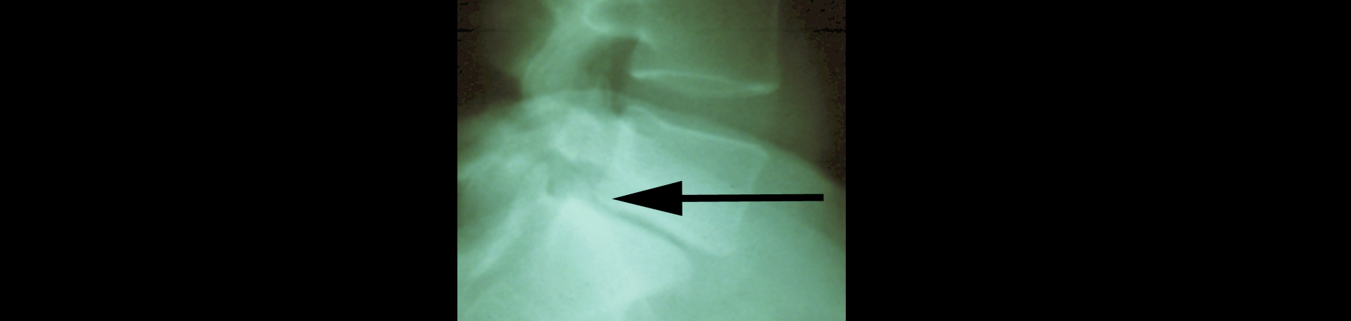 Juneau spondylolisthesis 