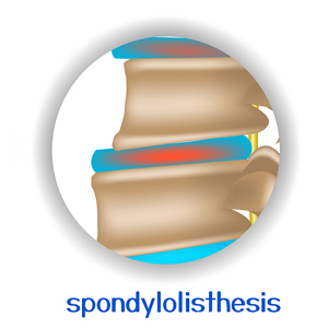picture of Juneau chiropractic spondylolisthesis