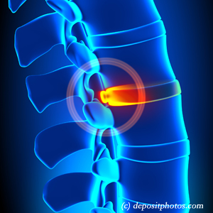 picture of lumbar Juneau disc herniation